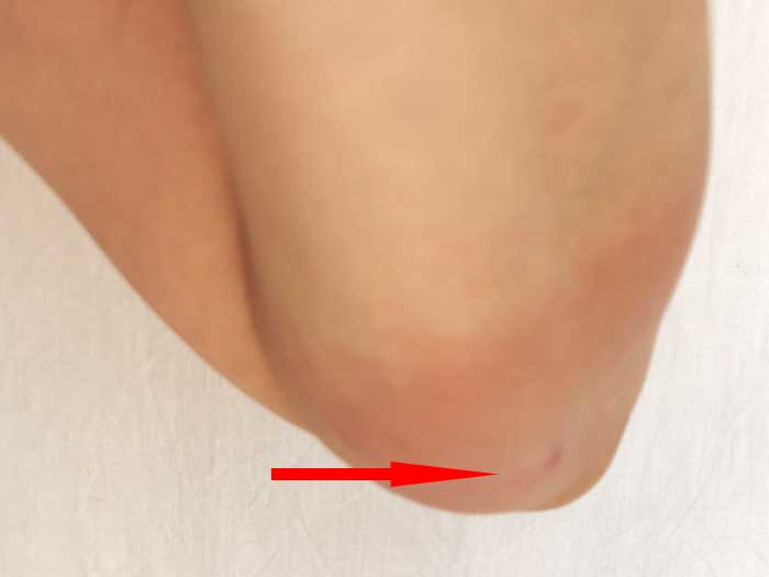 スズメバチに刺されて痛い！腕が腫れたので５時間ぐらい冷やしたよ