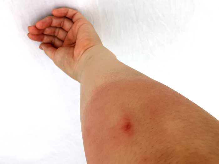 スズメバチに刺されて痛い！腕が腫れたので５時間ぐらい冷やしたよ