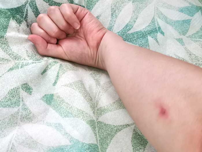 スズメバチに刺されて痛い！腕が腫れたので５時間ぐらい冷やしたよ